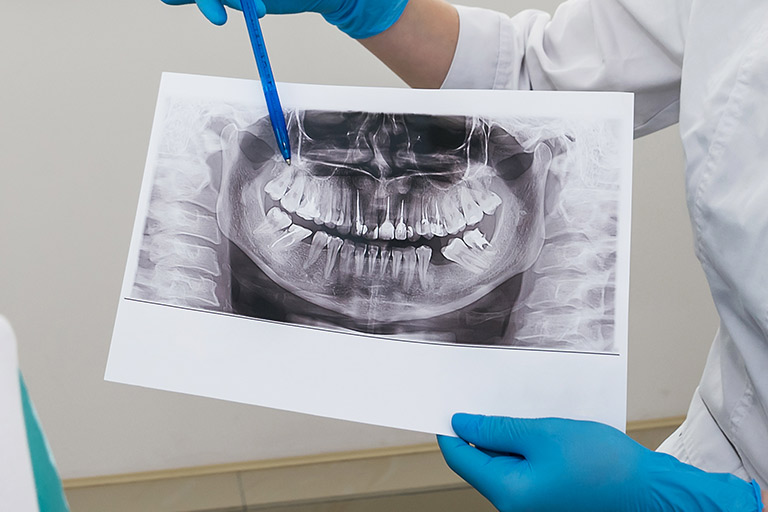 TIPOS DE RADIOGRAFÍAS DENTALES CLÍNICA DENTAL VILLALAÍN