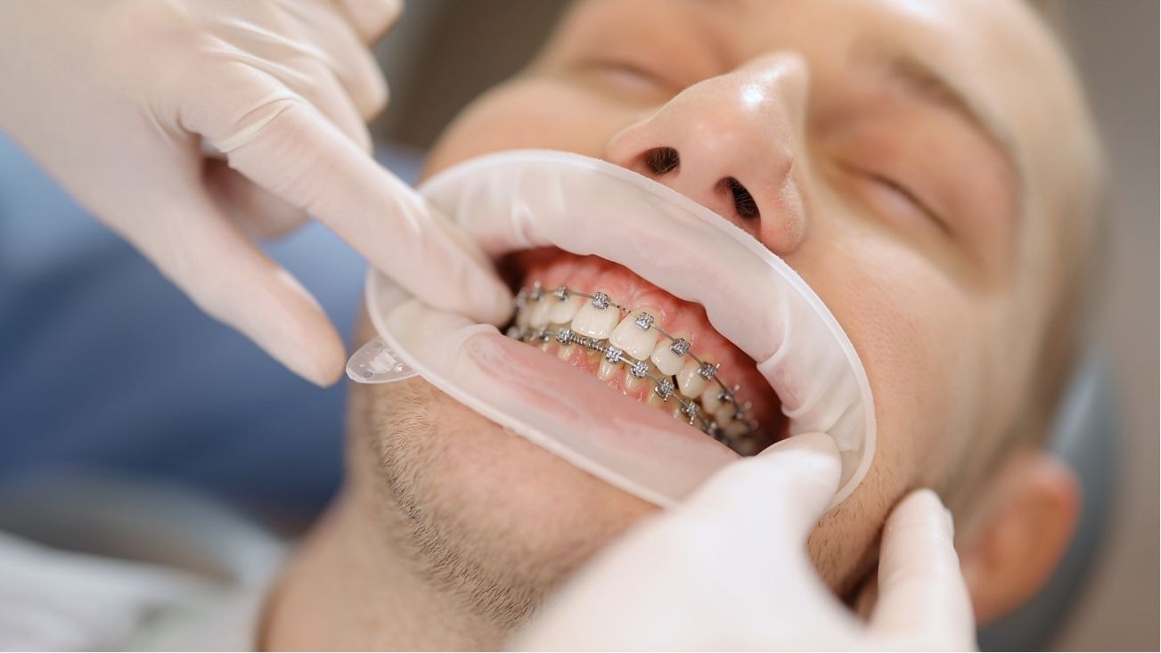 Dentista en Avilés ortodoncia en adultos 